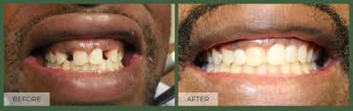 Dental implant before and after in Cary NC