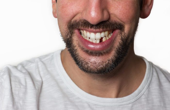 Dentists in Cary NC discuss lost teeth options