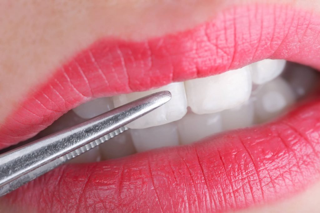 Close-up of a person's mouth with bright red lips, as dental tweezers hold a dental veneer or whitening strip near the front teeth.