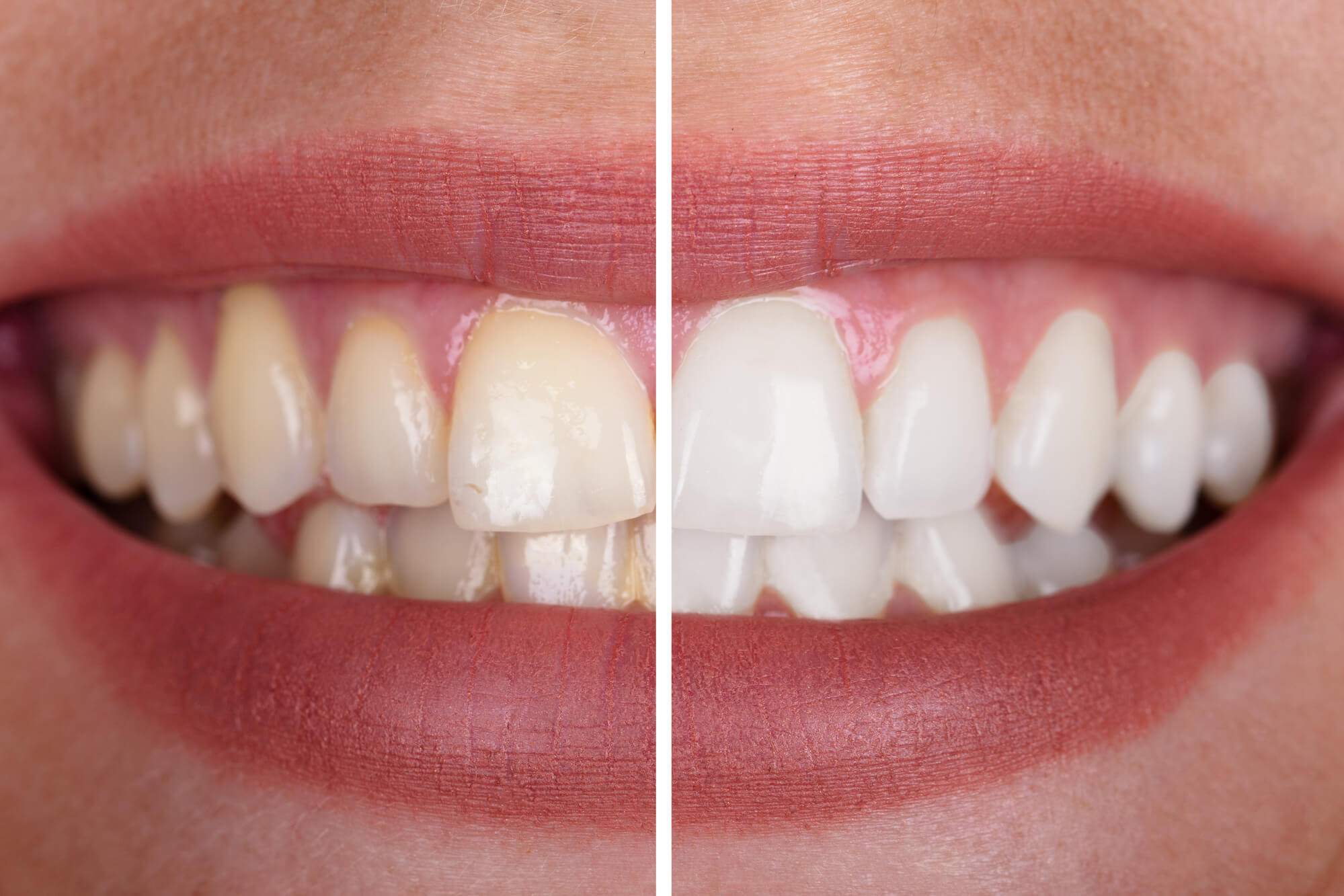 cosmetic dentist in Raleigh shows how teeth whitening works on a close up image smile