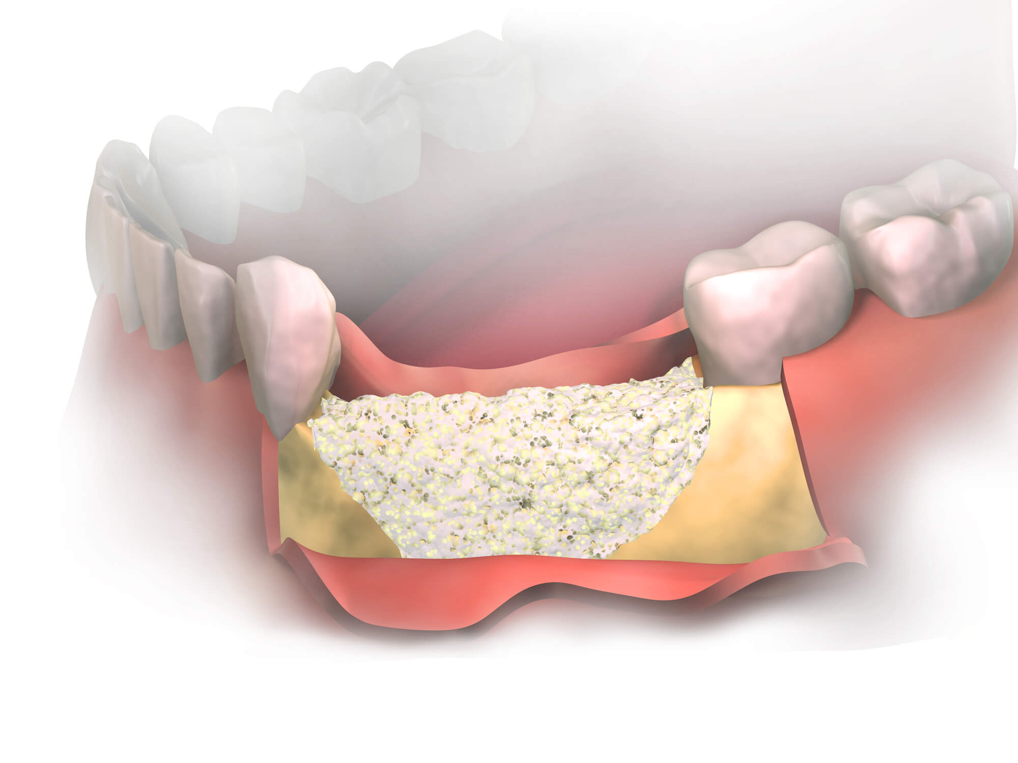 close up image of bone loss needing dental bone graft raleigh