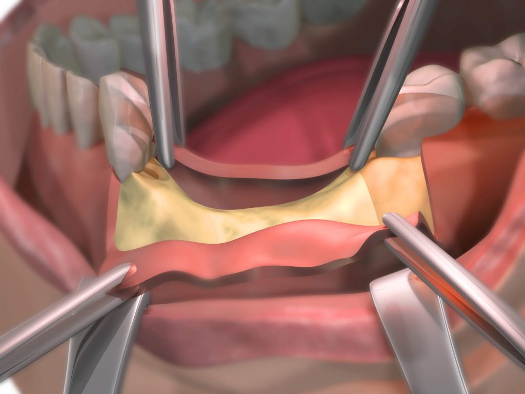 dental bone graft raleigh procedure