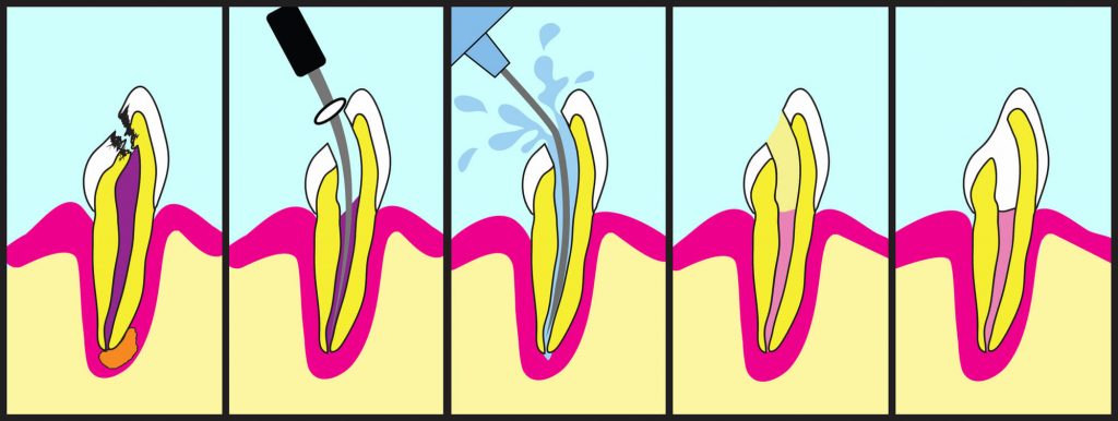Illustration of root canals in Raleigh