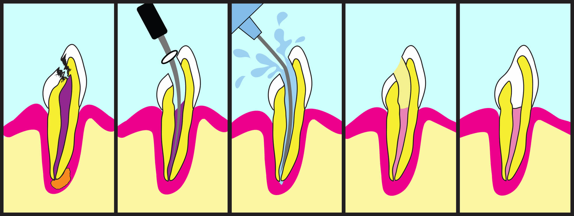 The Benefits of Getting Root Canals