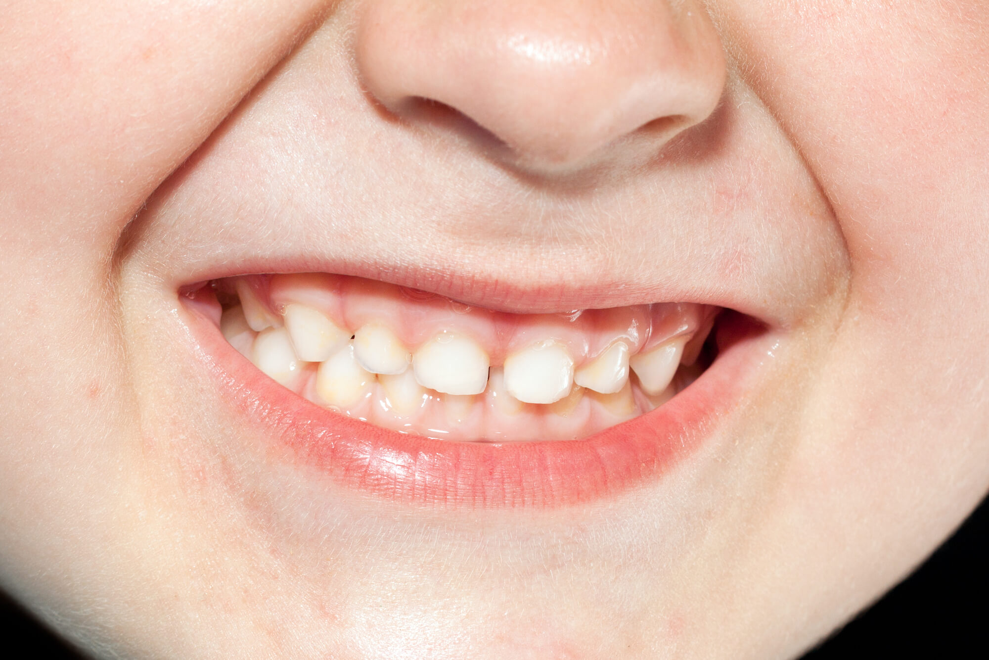 a healthy smile after seeing a Pediatric Dentist in Raleigh