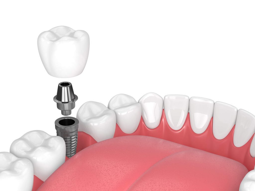 close up image of Dental Implants in Wendell in jawbone