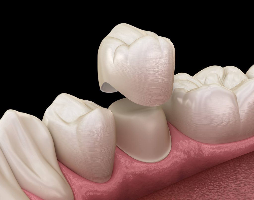 3D render of Dental Crown in Zebulon