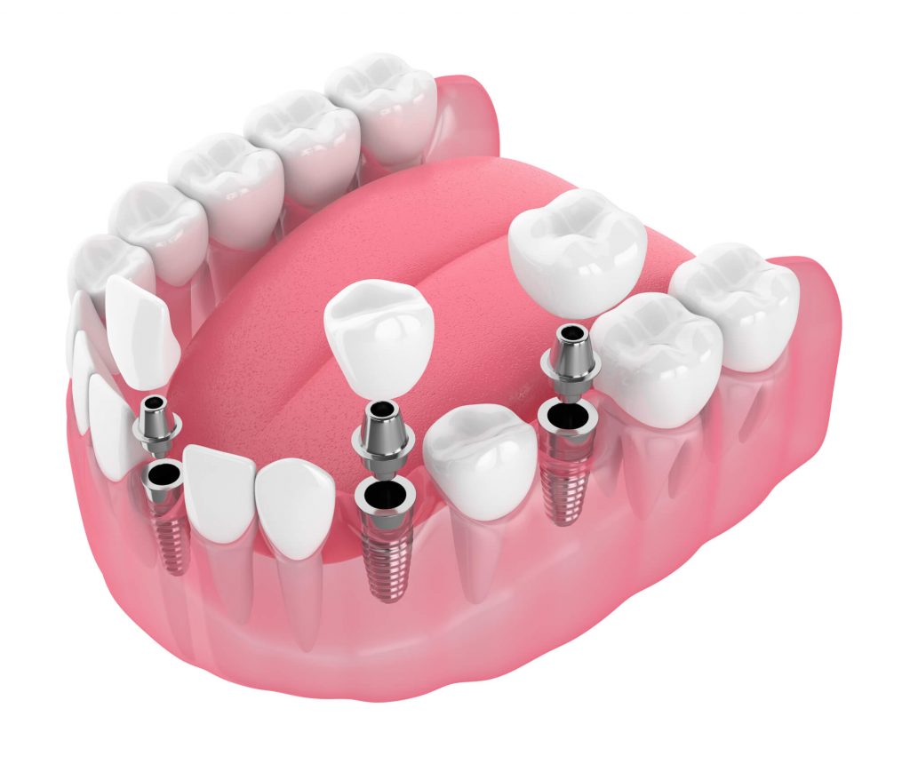 a closer look of dental implants in raleigh