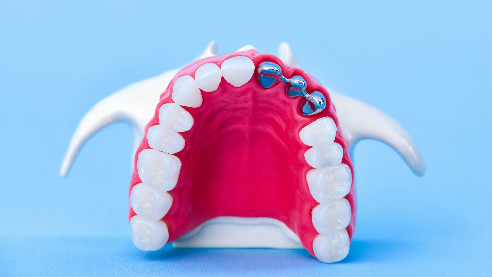 sample-of-crown-and-tooth-implant