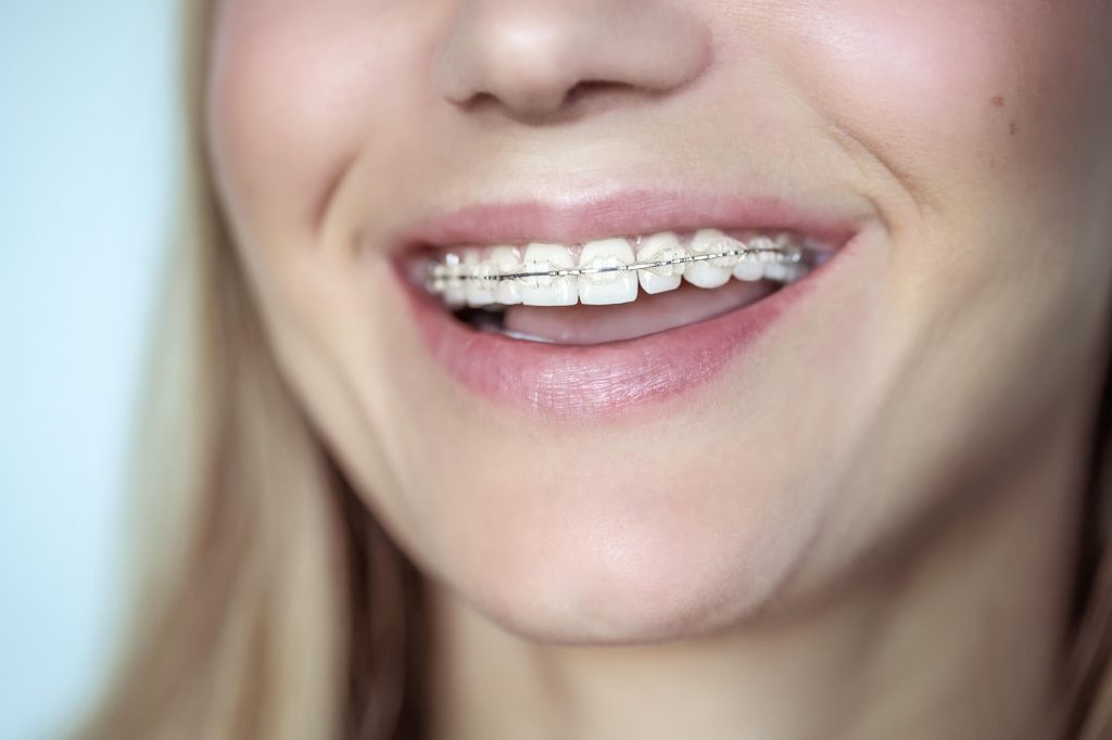 woman wearing metal braces from cosmetic dentistry in Raleigh, NC