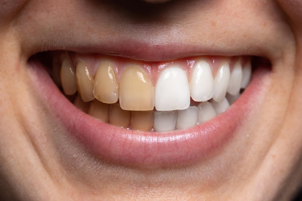 whitened teeth thanks to cosmetic dentistry in Raleigh, NC