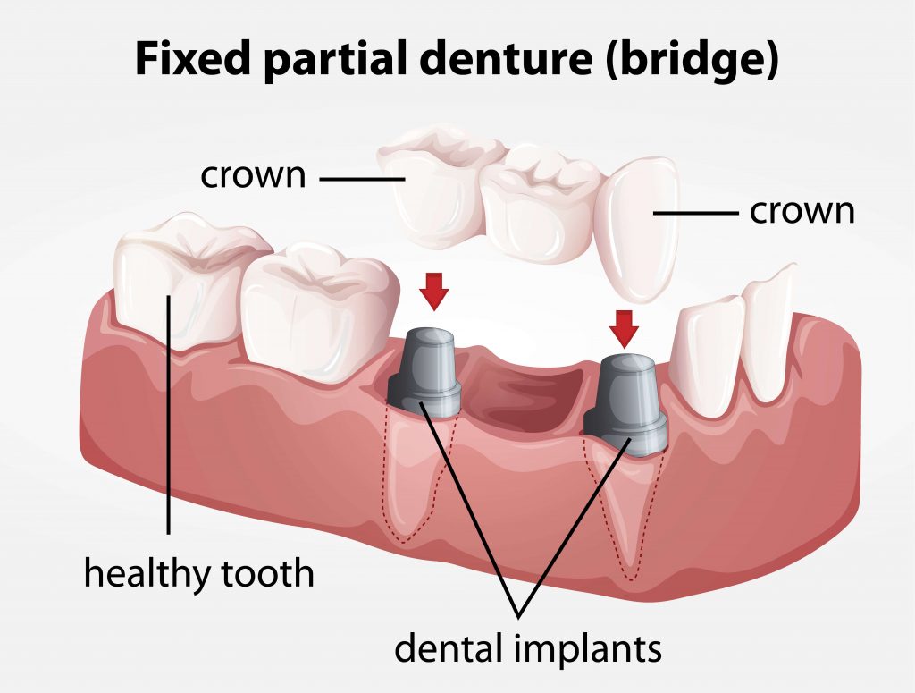 illustration of dental implants by a dentist Wendell