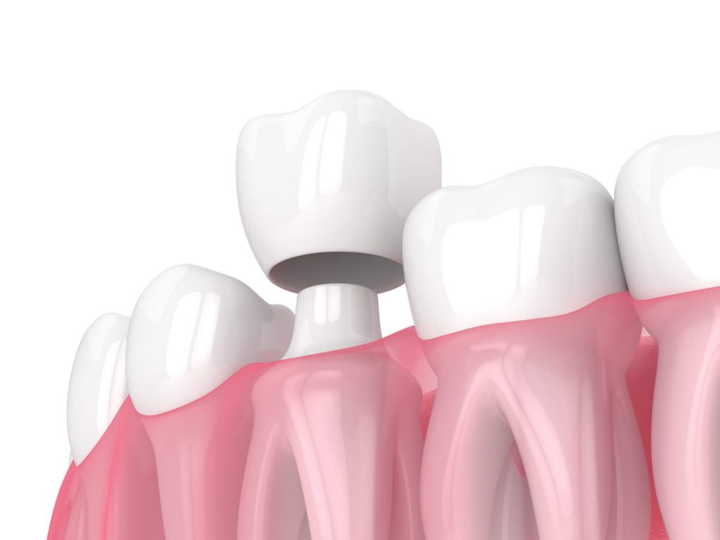 3D illustration of dental crown Wendell