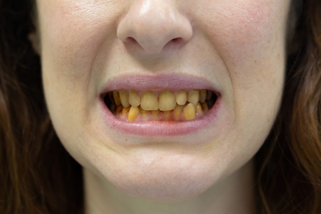 woman who needs teeth whitening in Raleigh, NC because of her stained teeth