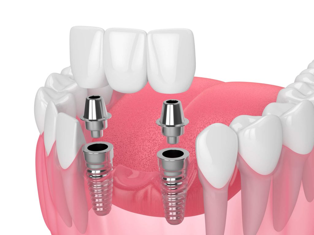 diagram dental implants Clayton 