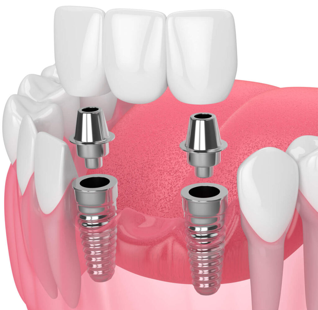 All on 4 diagram dental implants Clayton