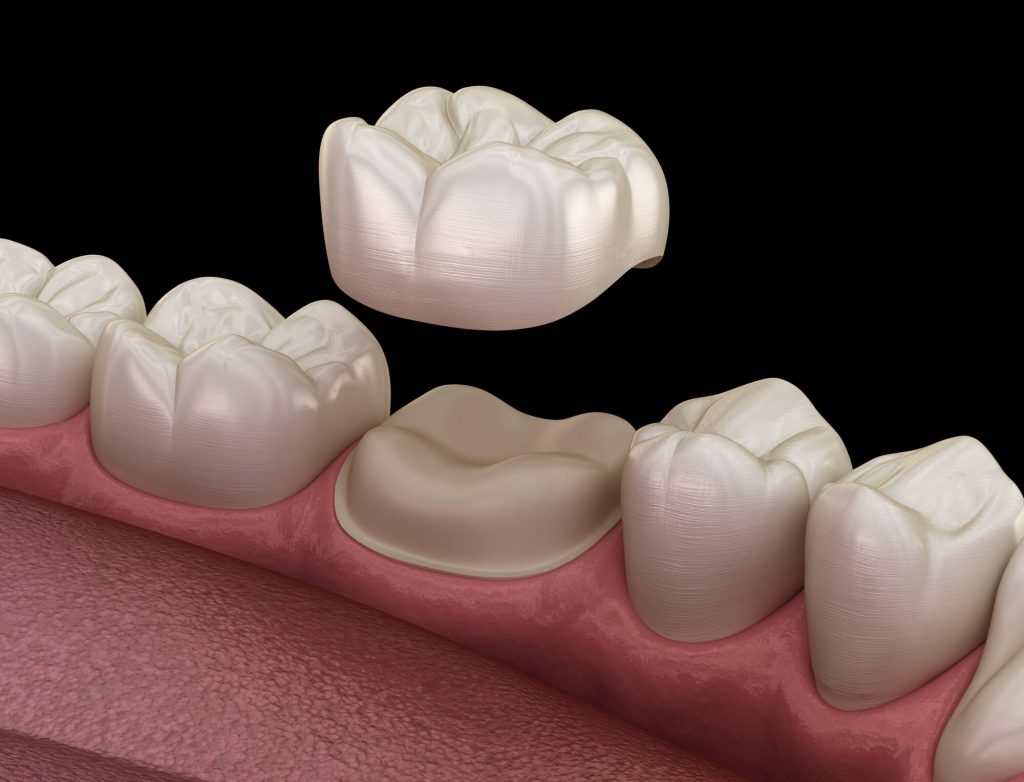 molar and dental crown Wendell