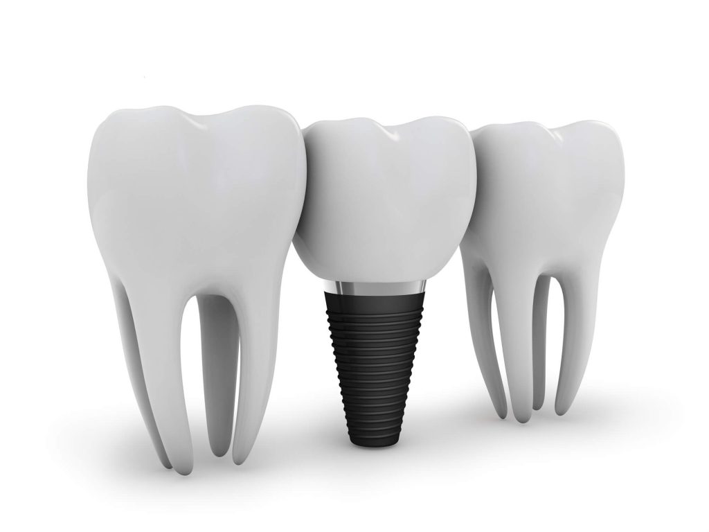 3D render of a dental implant in between two natural teeth