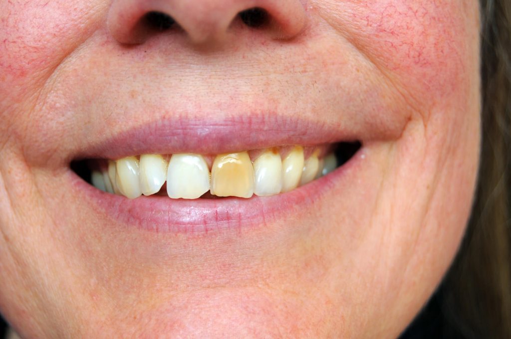 woman with stained tooth and needs teeth whitening in Raleigh, NC