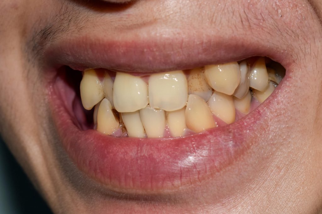 tooth discoloration that needs teeth whitening in Raleigh, NC