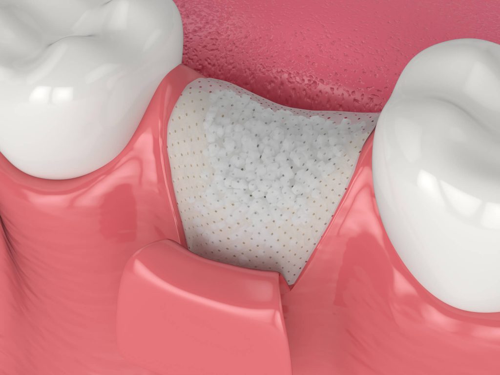 3D render of dental bone grafting Raleigh