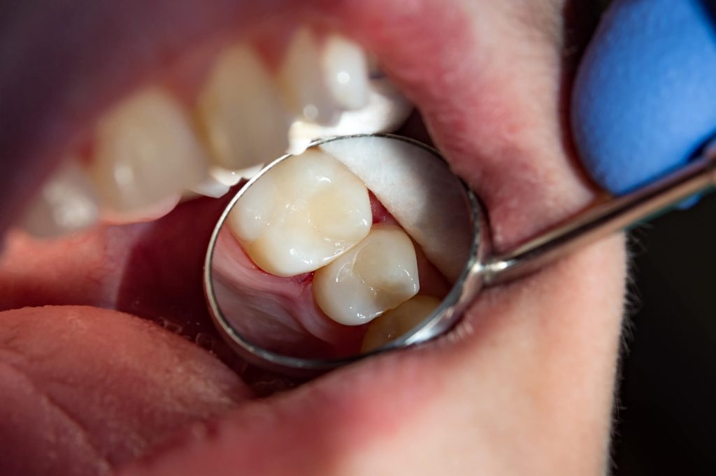 dental mirror shows what a molar looks like after getting composite fillings Raleigh