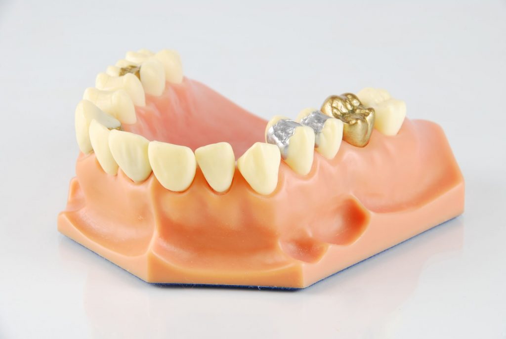 teeth model with composite fillings Raleigh