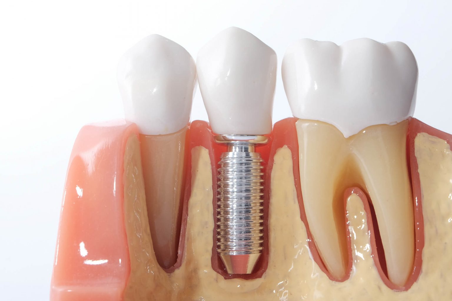 Common Issues With Dental Implants and How to Fix Them