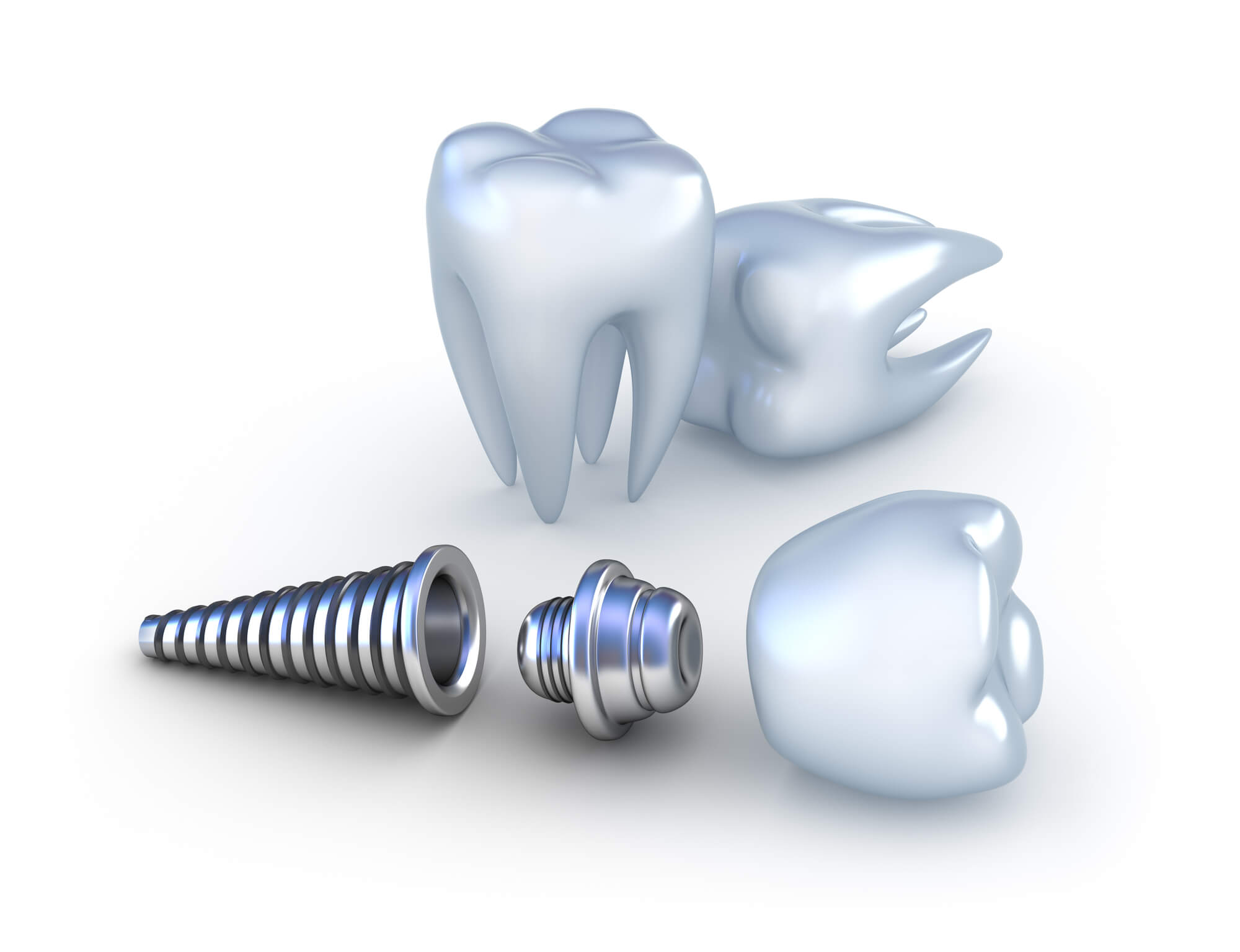 Top Issues That Are Stopping You From Getting Dental Implants