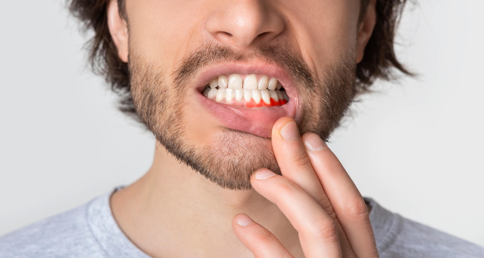 What Are the Different Stages of Gum Disease?