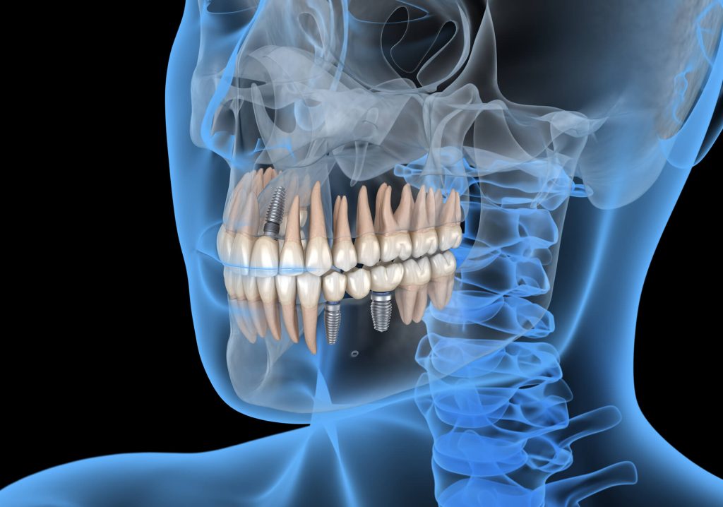 3D front view of dental implants in Raleigh