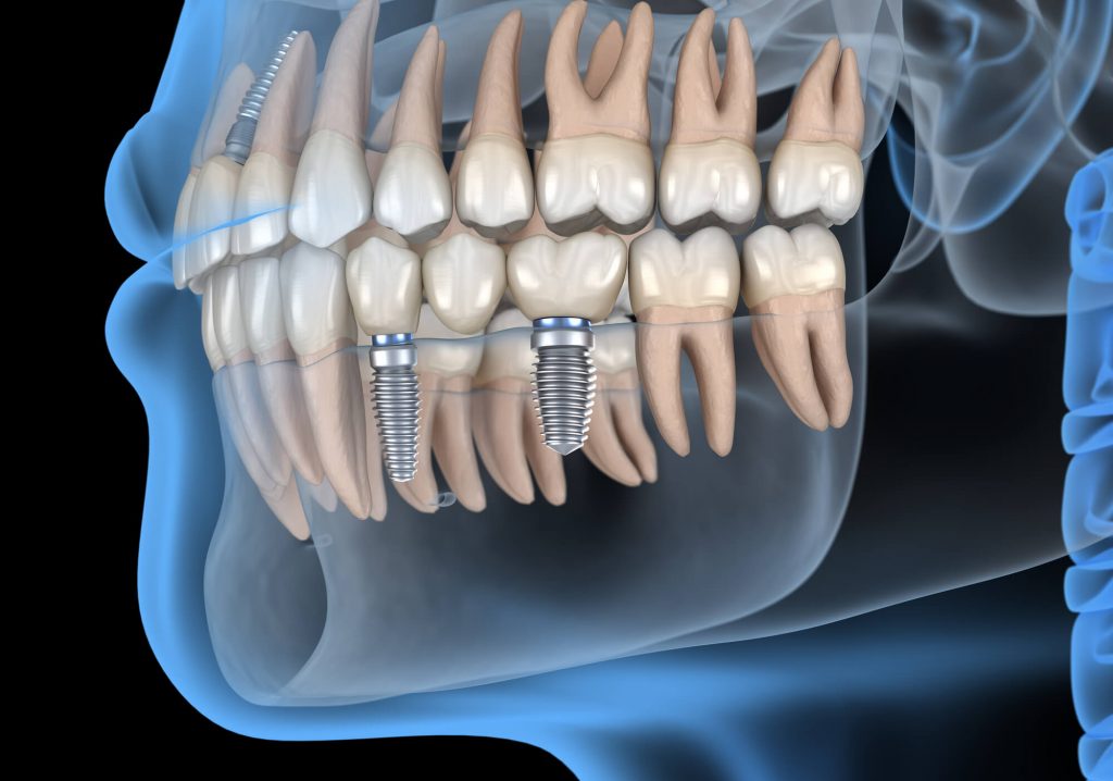 3D of dental implants in Raleigh