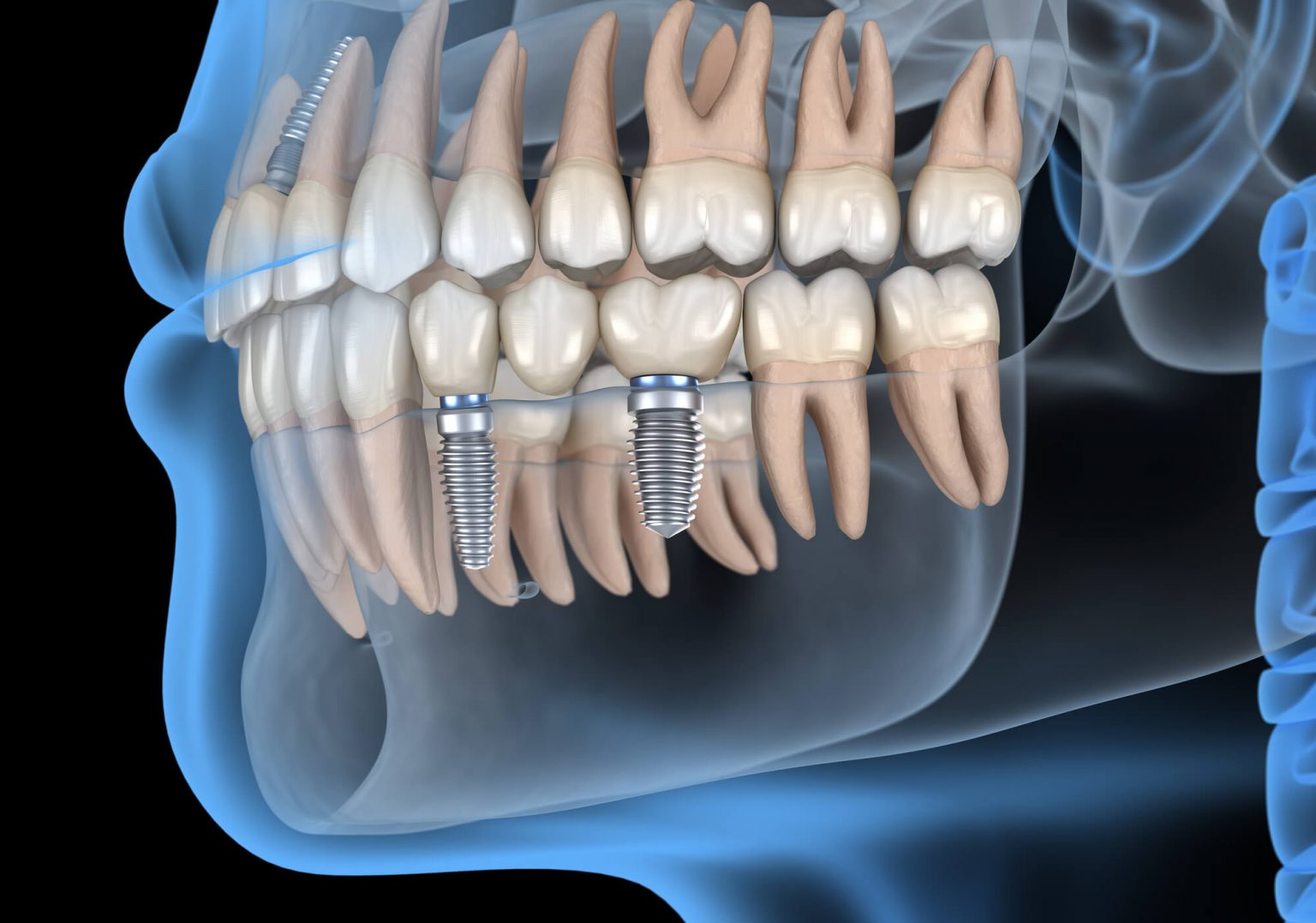 How to Prepare for Dental Implant Surgery