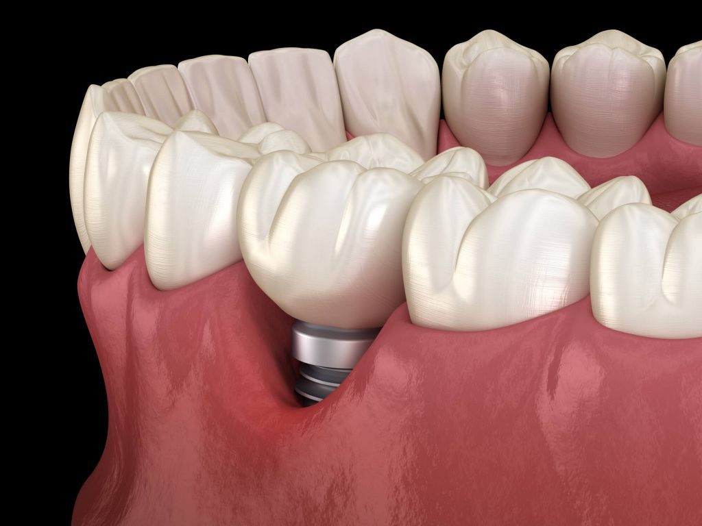3D computer image of dental implants in Wendell