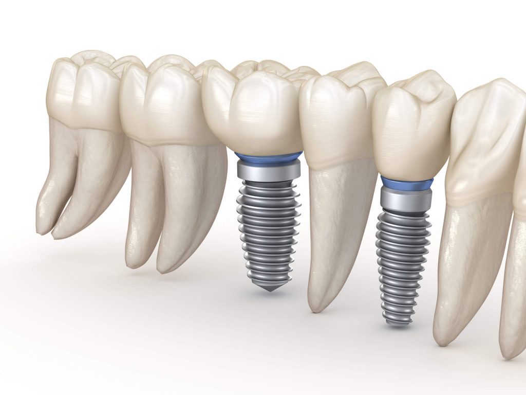 illustration of dental implants in Raleigh