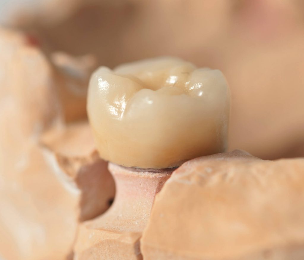 close up image of dental implants in Wendell
