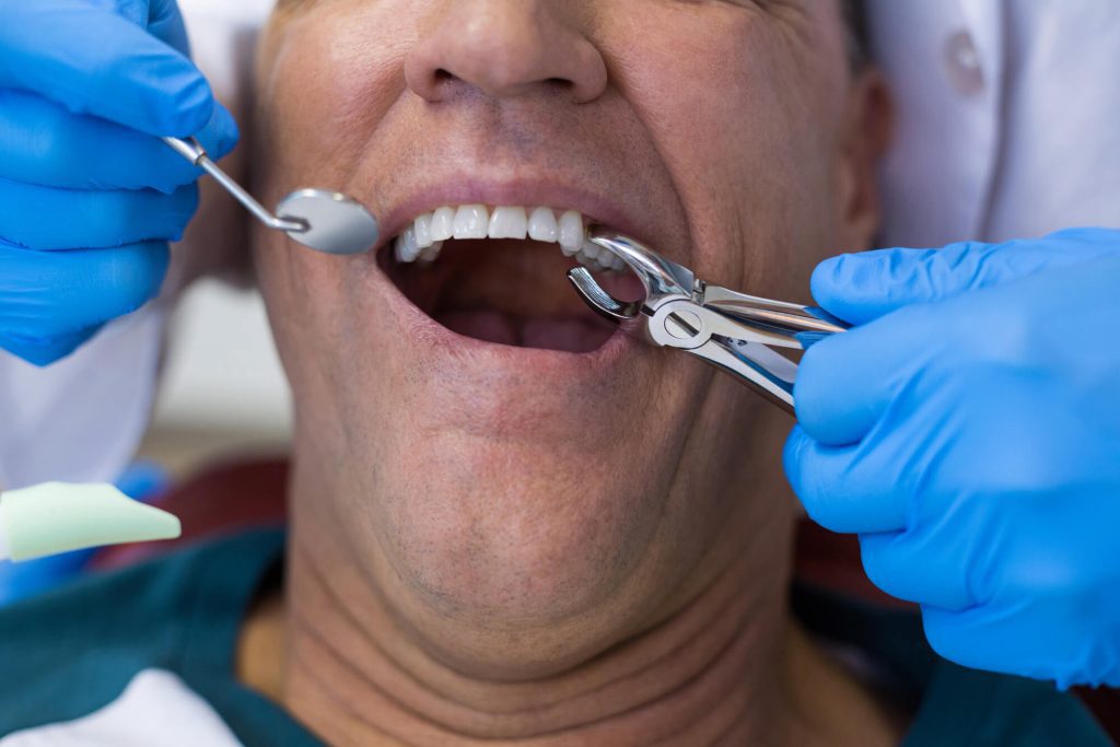 family dentist in Raleigh performs simple tooth extraction