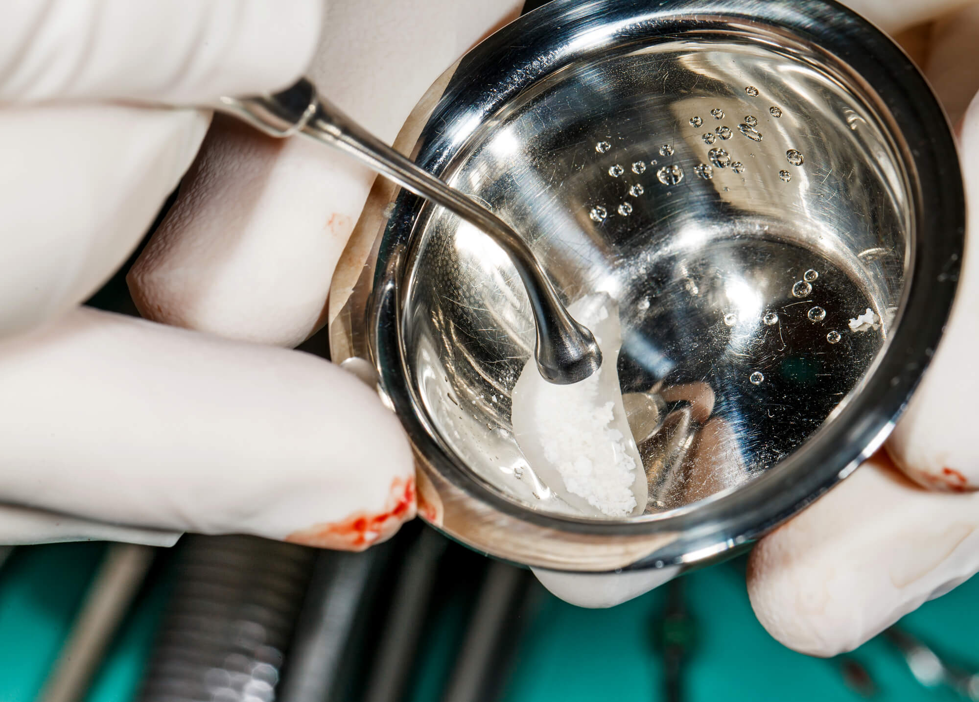 dental bone grafting in raleigh for dental implants