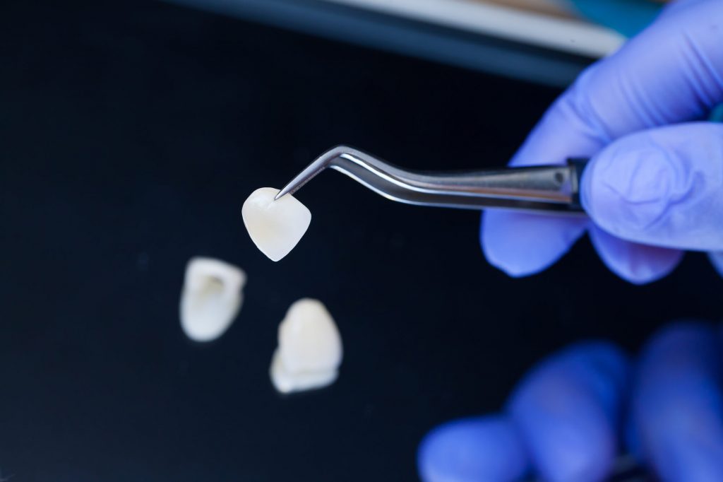 Dental tooth veneers being prepared for fitment in Raleigh NC