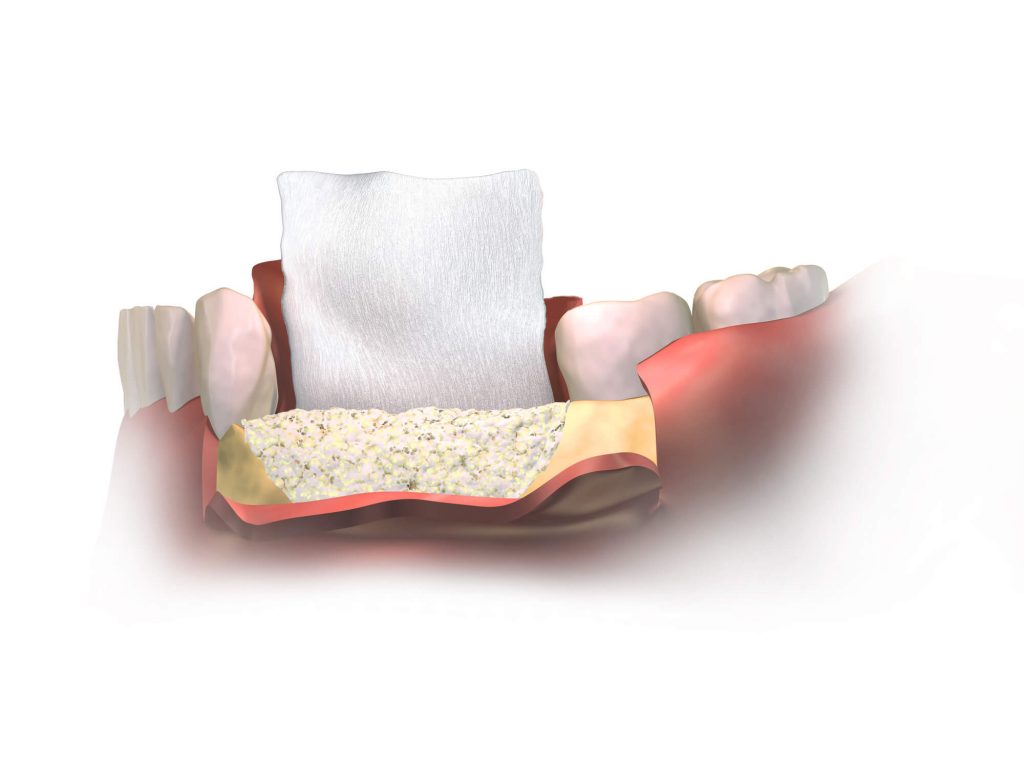 3D image of dental bone grafting in raleigh 
