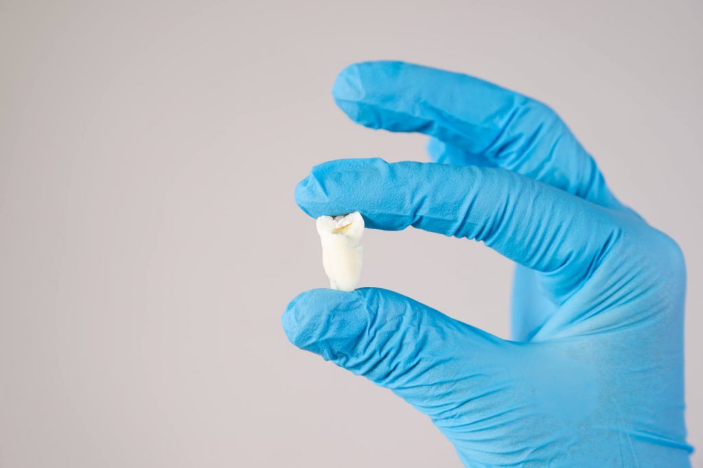 family dentist in Raleigh holds an extracted tooth in gloved hand