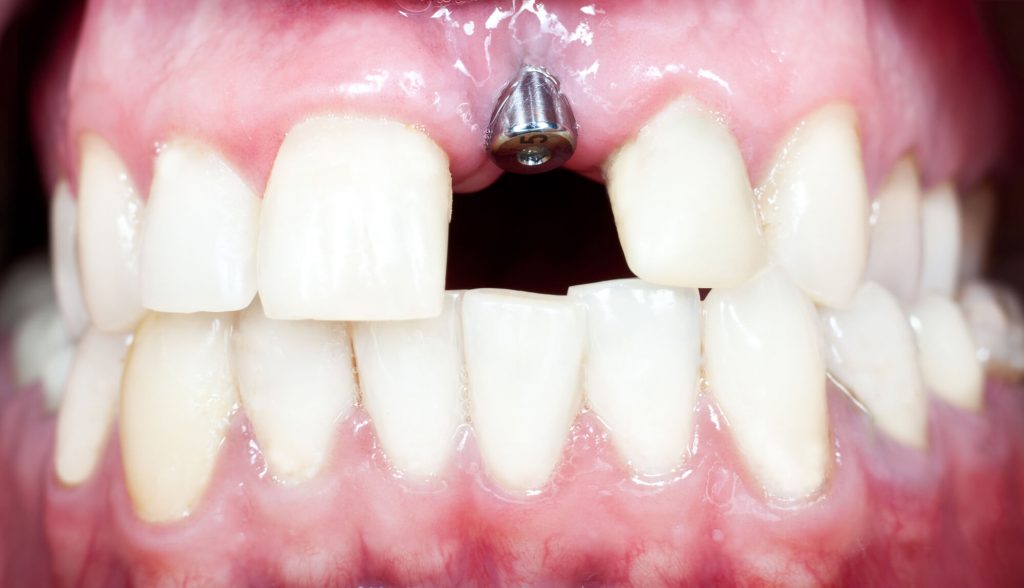 close up image of dental implants in Zebulon