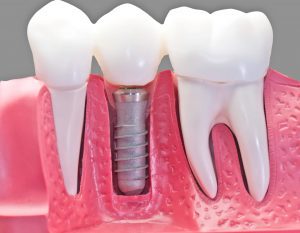 dental implants in Zebulon model