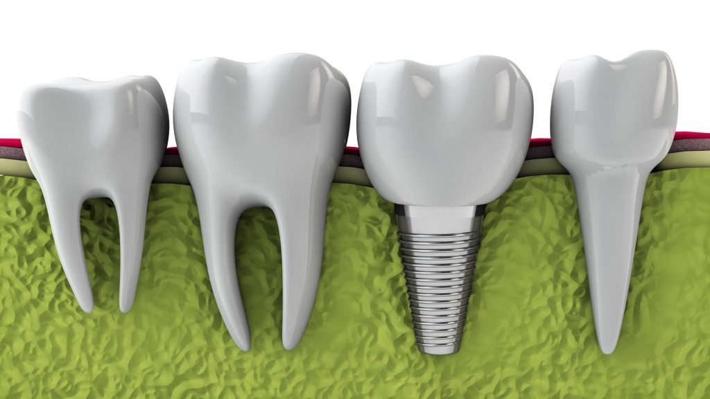dental implants illustration in Wendell