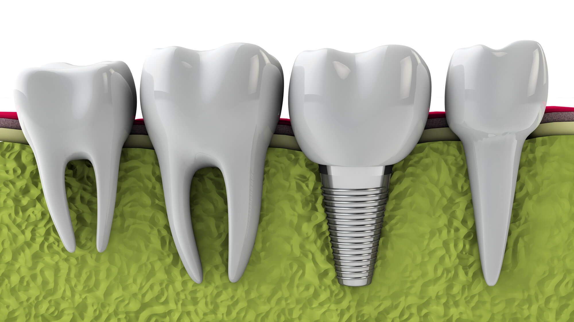 implant dentures Carolina