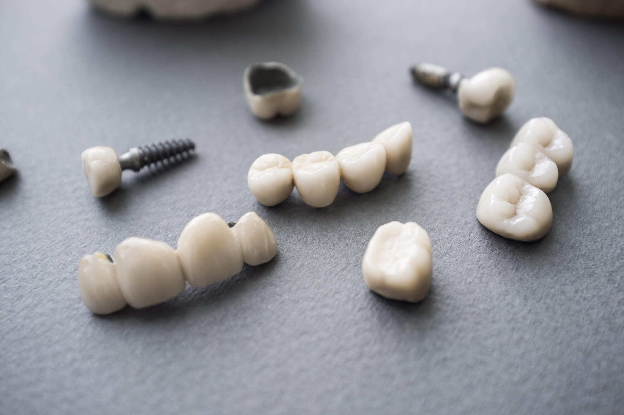 dental crown in Wilson and dental implants