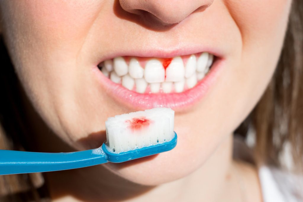 woman with bleeding gums needing a dentist in Clayton